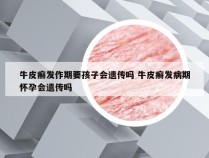 牛皮癣发作期要孩子会遗传吗 牛皮癣发病期怀孕会遗传吗