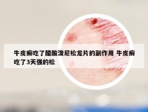 牛皮癣吃了醋酸泼尼松龙片的副作用 牛皮癣吃了3天强的松
