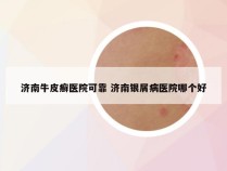 济南牛皮癣医院可靠 济南银屑病医院哪个好