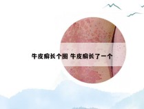 牛皮癣长个圈 牛皮癣长了一个