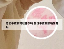 老公牛皮癣可以怀孕吗 男性牛皮癣影响生育吗