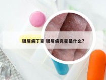 银屑病丁克 银屑病克星是什么?