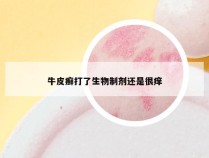 牛皮癣打了生物制剂还是很痒