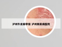 泸州牛皮癣举报 泸州银屑病医院