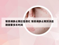 银屑病静止期还是很红 银屑病静止期到消退期需要多长时间