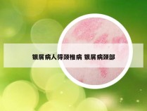 银屑病人得颈椎病 银屑病颈部