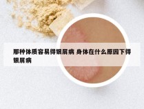 那种体质容易得银屑病 身体在什么原因下得银屑病