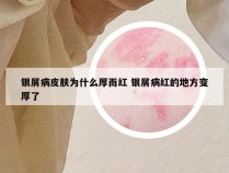 银屑病皮肤为什么厚而红 银屑病红的地方变厚了