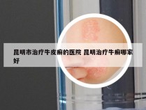 昆明市治疗牛皮癣的医院 昆明治疗牛癣哪家好