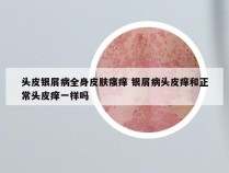 头皮银屑病全身皮肤瘙痒 银屑病头皮痒和正常头皮痒一样吗