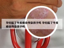 孕妇起了牛皮癣会传染孩子吗 孕妇起了牛皮癣会传染孩子吗
