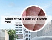 新兴县清理牛皮癣专业公司 新兴皮肤病医院正规吗