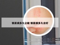 银屑病多久公破 银屑病多久会好