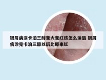 银屑病涂卡泊三醇变大变红该怎么消退 银屑病涂完卡泊三醇以后比原来红