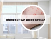 银屑病瘙痒搽什么药 银屑病瘙痒吃什么药