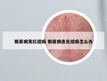银屑病发红结痂 银屑病患处结痂怎么办