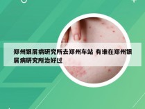 郑州银屑病研究所去郑州车站 有谁在郑州银屑病研究所治好过