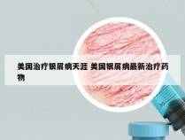 美国治疗银屑病天涯 美国银屑病最新治疗药物