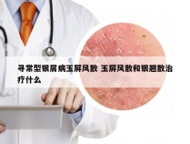 寻常型银屑病玉屏风散 玉屏风散和银翘散治疗什么
