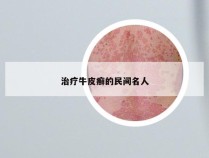 治疗牛皮癣的民间名人