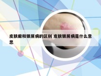 皮肤廨和银屑病的区别 皮肤银屑病是什么意思