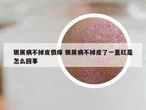 银屑病不掉皮很痒 银屑病不掉皮了一直红是怎么回事