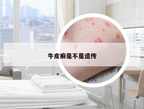 牛皮癣是不是遗传