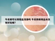 牛皮癣可以用粗盐泡澡吗 牛皮肤癣用盐水洗有好处嘛?