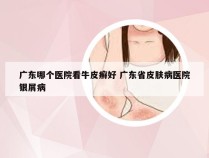 广东哪个医院看牛皮癣好 广东省皮肤病医院银屑病