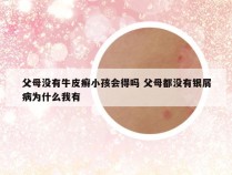 父母没有牛皮癣小孩会得吗 父母都没有银屑病为什么我有