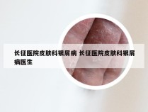 长征医院皮肤科银屑病 长征医院皮肤科银屑病医生