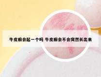 牛皮癣会起一个吗 牛皮癣会不会突然长出来
