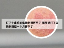 打了牛皮癣的生物制剂怀孕了 银屑病打了生物制剂后一个月怀孕了