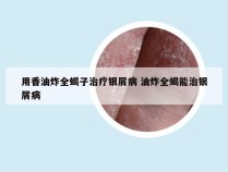 用香油炸全蝎子治疗银屑病 油炸全蝎能治银屑病