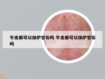 牛皮癣可以抹炉甘石吗 牛皮癣可以抹炉甘石吗