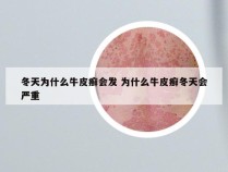 冬天为什么牛皮癣会发 为什么牛皮癣冬天会严重