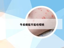 牛皮癣能不能吃樱桃