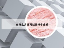 有什么方法可以治疗牛皮癣