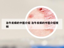 治牛皮癣的中医介绍 治牛皮癣的中医介绍视频