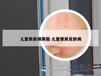 儿童银屑病黑圈 儿童银屑皮肤病