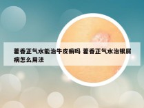 藿香正气水能治牛皮癣吗 藿香正气水治银屑病怎么用法