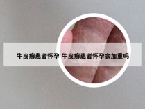 牛皮癣患者怀孕 牛皮癣患者怀孕会加重吗