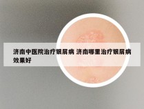 济南中医院治疗银屑病 济南哪里治疗银屑病效果好