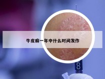 牛皮癣一年中什么时间发作