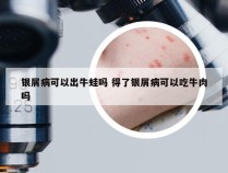 银屑病可以出牛蛙吗 得了银屑病可以吃牛肉吗