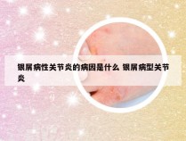 银屑病性关节炎的病因是什么 银屑病型关节炎
