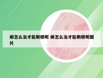 癣怎么治才能断根呢 癣怎么治才能断根呢图片