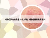 对称型牛皮癣是什么样的 对称性银屑病图片