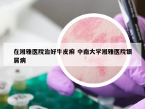 在湘雅医院治好牛皮癣 中南大学湘雅医院银屑病