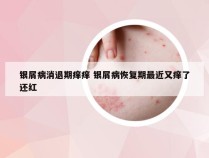 银屑病消退期痒痒 银屑病恢复期最近又痒了还红